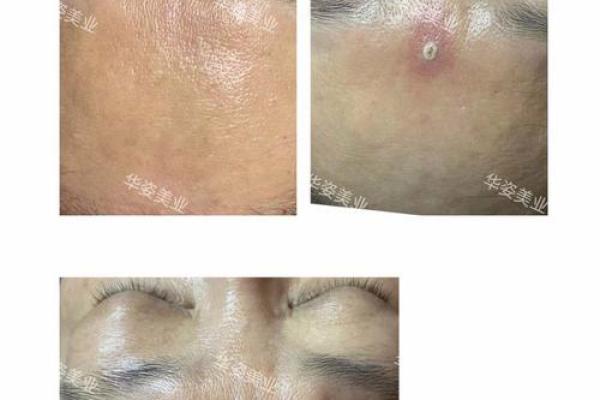 男性如何通过点痣打造自信魅力