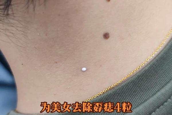 男性如何通过点痣打造自信魅力