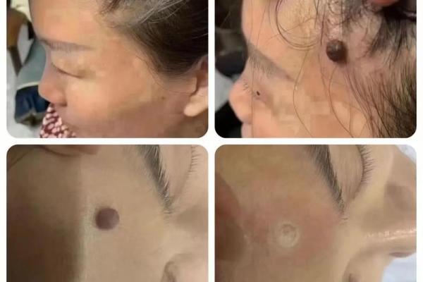 起痣相与命运之间的微妙联系