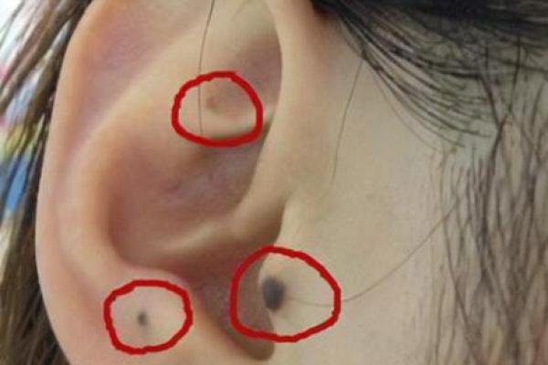 痣相与命运的关系：科学视角与传统观点