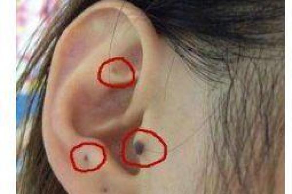 痣相水险的含义与解读：如何看待身上的水险痣