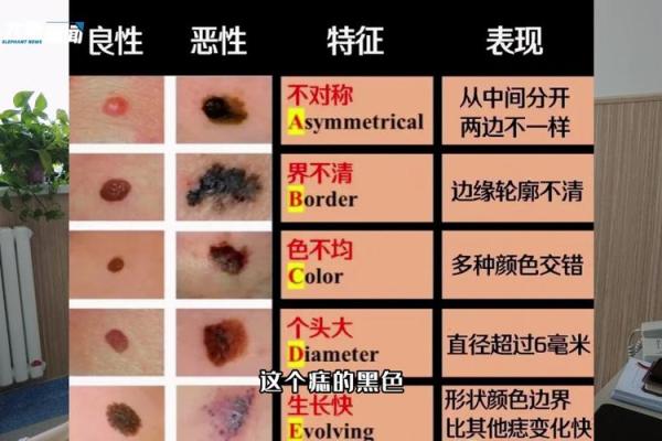 从痣相看风水：痣的形状和颜色揭示你的命运走向