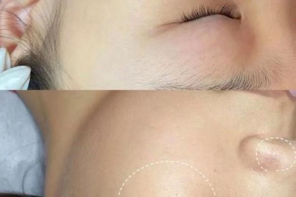 男性点痣与面部气质提升的关系