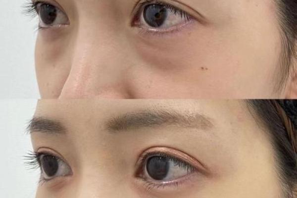 眼袋纹面相：揭秘面相中的岁月痕迹