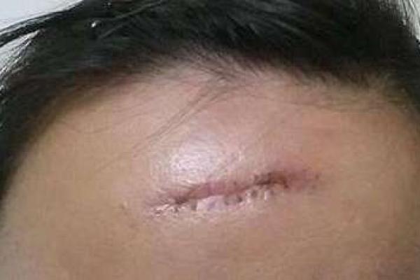 额头现红线：预示何种运势？