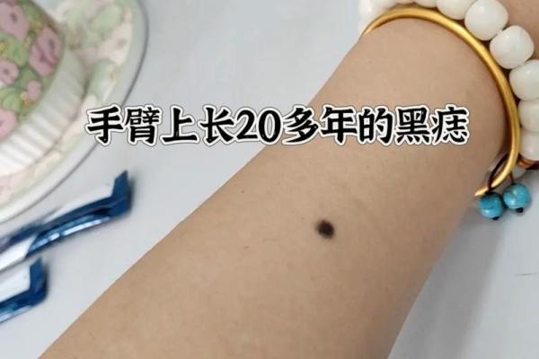 左胳膊头痣男子走红，网友纷纷求同款