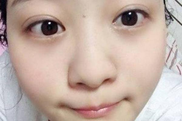 一痣定终身？泪堂痣背后的惊人真相