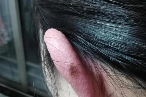 耳朵上的小秘密：女人耳相痣的神秘力量！