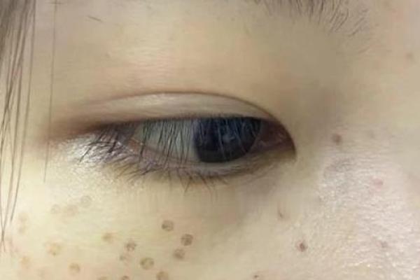 眼周雀斑面相：洞察命运与性格的神秘符号