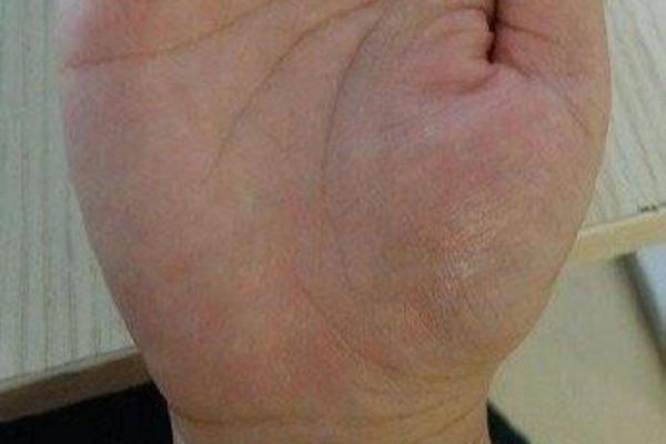看手相识癌症？岛纹暗示你需要注意什么？