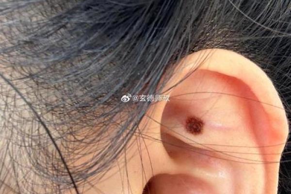 耳背痣揭秘：你的运势如何？