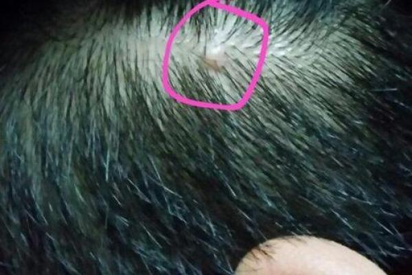 头皮肉痣：你的头部隐藏着哪些秘密？