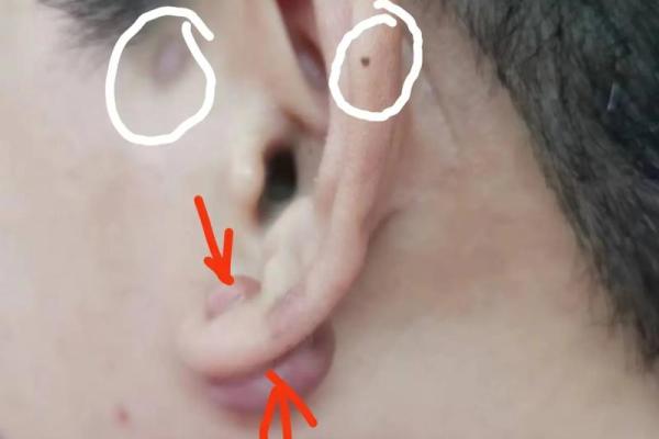 独家揭秘：耳朵右上有痣的秘密！