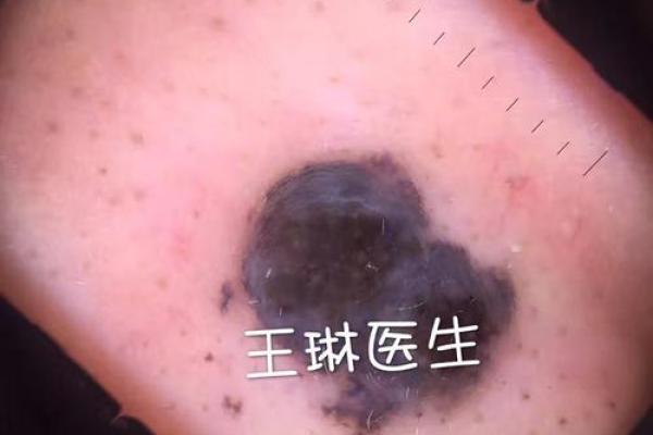 三角区痣相揭秘：命运之痣，财富运势一触即发！